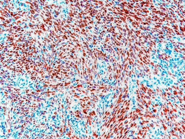 HHS Doubles AI-Backed Childhood Cancer Research Funding Expression of HHV-8 LANA in Pediatric Kaposi Sarcoma