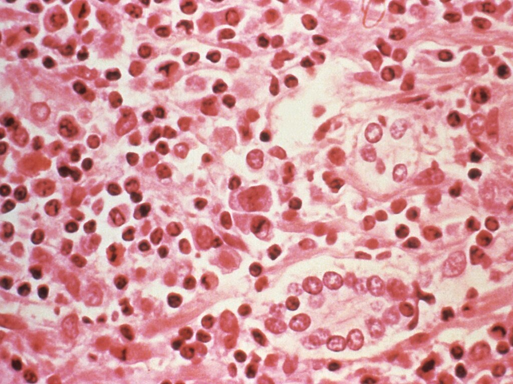 Three dead in suspected hantavirus outbreak on Atlantic cruise ship | Health News
